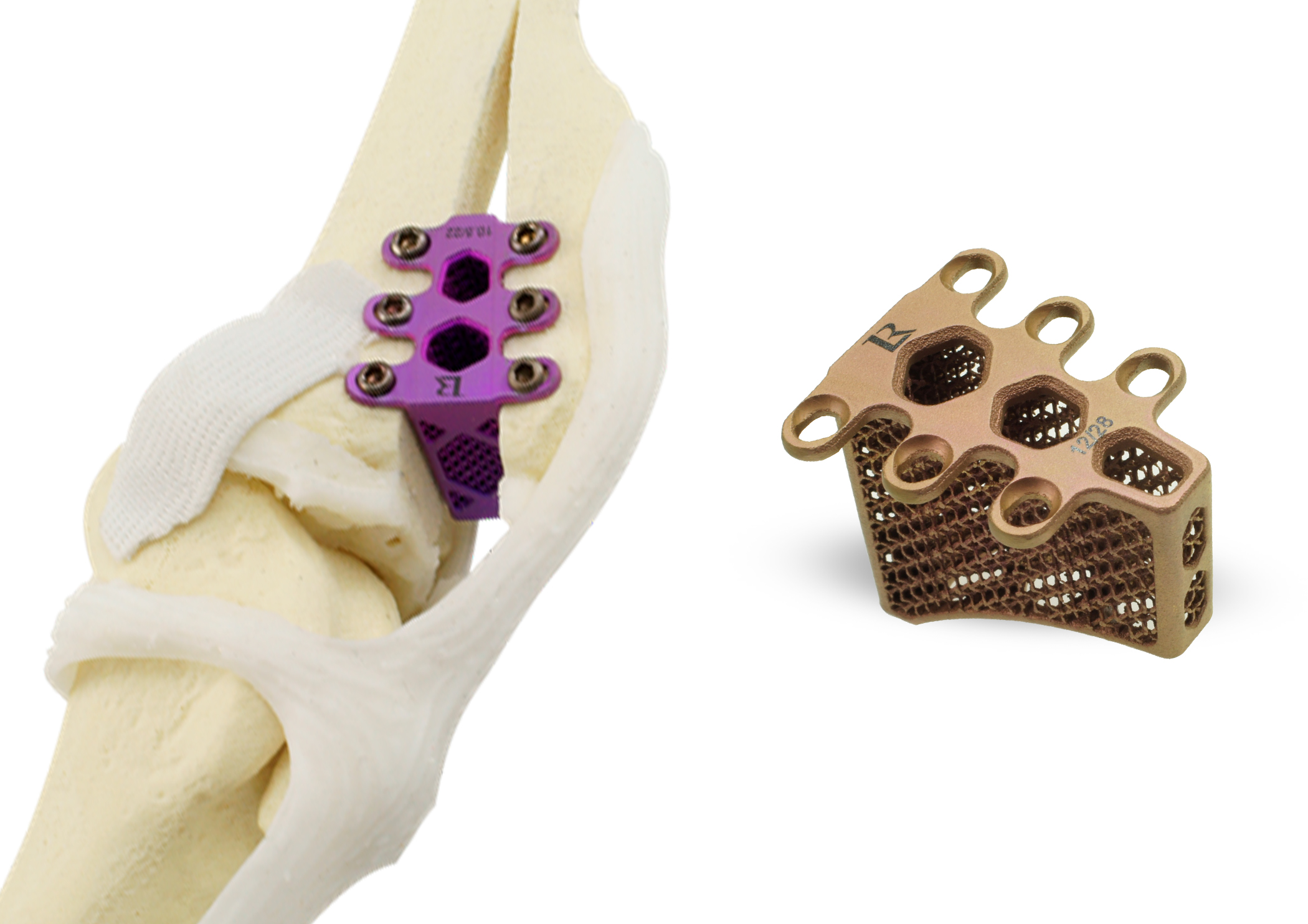 Rita Leibinger Medical, 3D Printed Titanium Implants